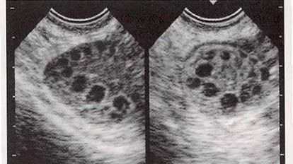 怀孕六周香港验血是男孩准吗,女性多囊卵巢综合征需要做试管婴儿才能怀孕吗