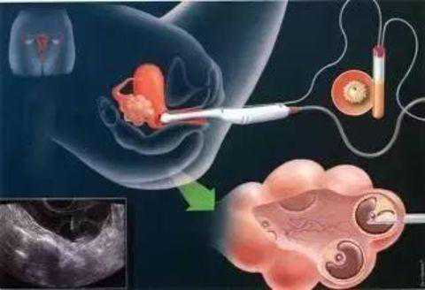 香港验血的性别准确吗,莲花宝宝：试管婴儿出现这些情况需要延迟胚胎移植时