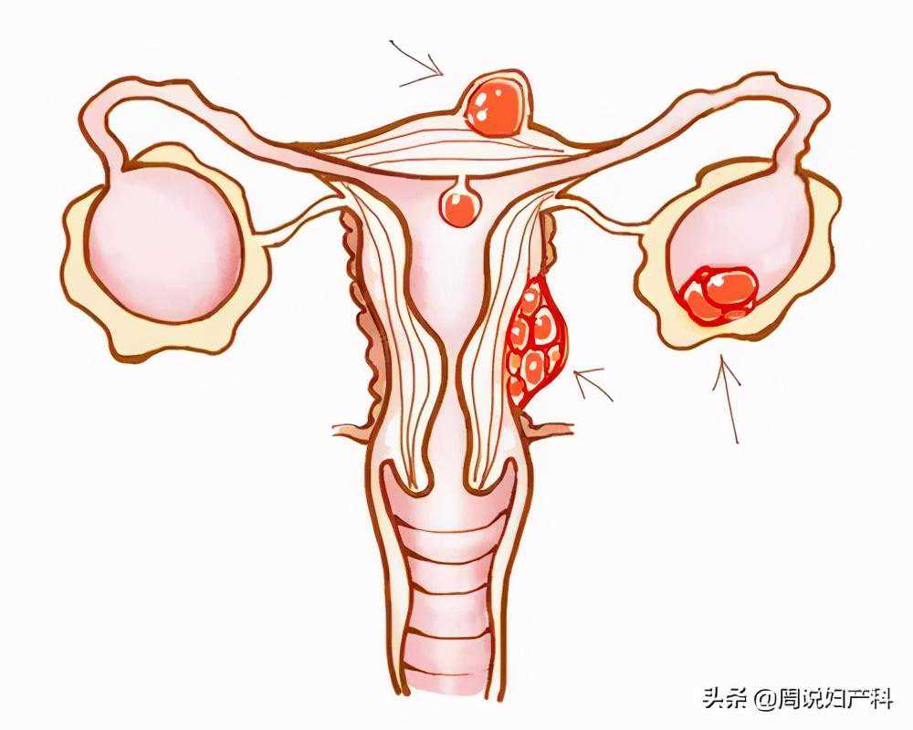 香港验血acgt准么,女性经期咳血是怎么回事？会是子宫内膜异位症吗？