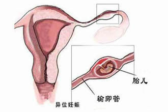 香港验血需要几周出结果,又是“宫外孕”！5年求子3次宫外孕，做试管婴儿就能